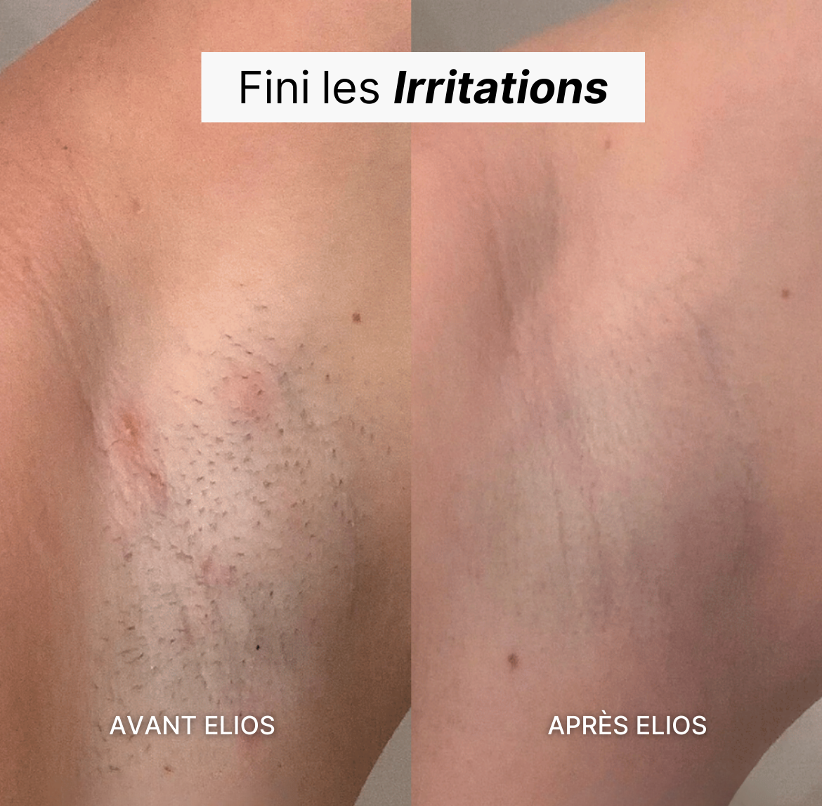 Elvéra™ | Rasoir Femme 5-en-1